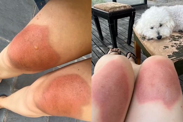 大热天穿破洞牛拿仔裤 女子膝盖晒成二度烫伤