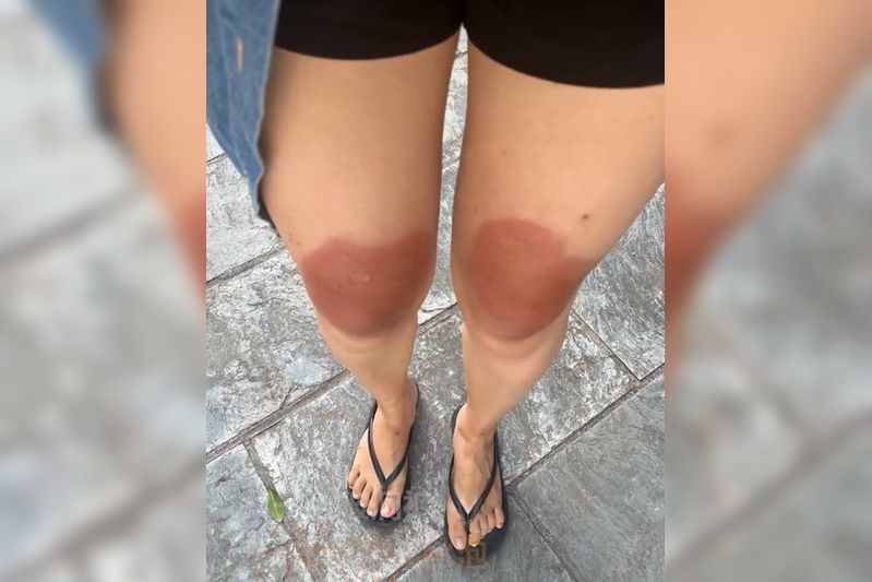 大热天穿破洞牛拿仔裤 女子膝盖晒成二度烫伤