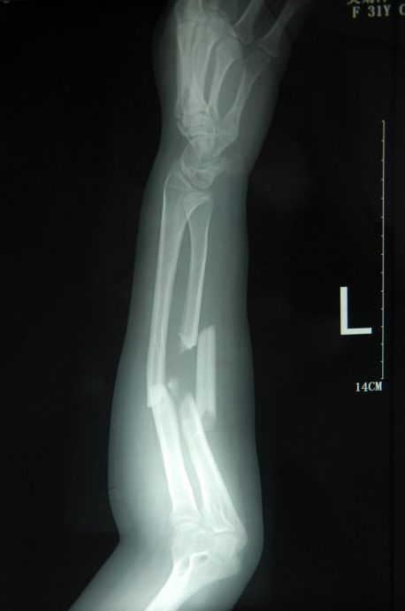 小酌也不安全!牛津研究:酒精导致「60种」疾病风险上升