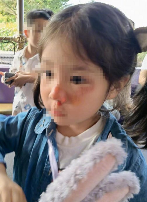 拚盘/上海迪士尼5岁妹惨遭“黄牛党”撞飞3公尺外 脸庞全伤恐毁容