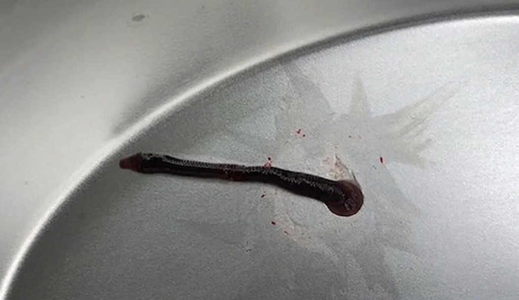 拼盘/8旬老翁用山泉水洗脸 屏荣就医取出6公分水蛭