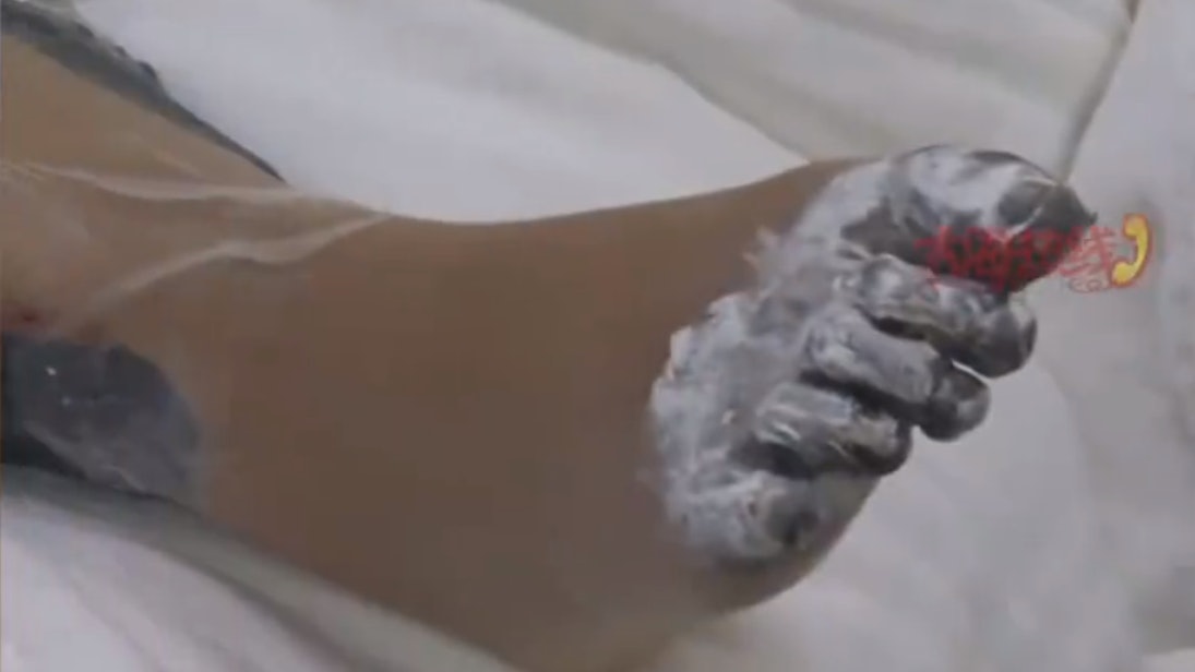 拼盘/iPhone充电遭电击 女孩内脏受损恐截肢 苹果官方拒赔引热议