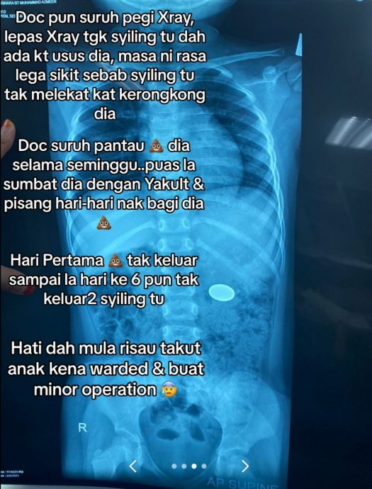 视频 | 小女儿把10仙当饼乾吞下!父:6天仍在体内 差点动手术