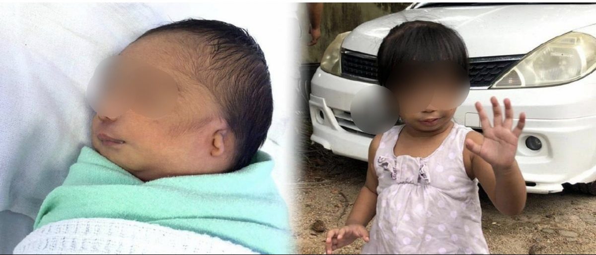 视频|2岁女童先天TCS脸部有缺陷 “她不是ET是我家小天使”