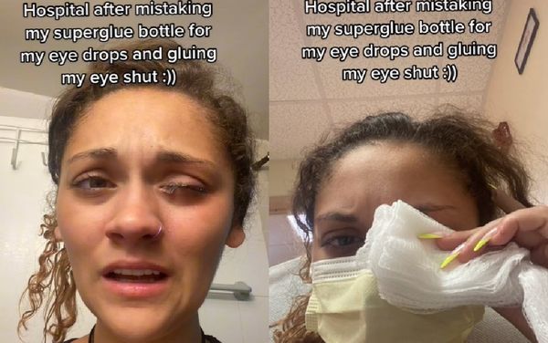 误把强力胶当成眼药水 22岁女“左眼紧紧黏住”崩溃片爆红