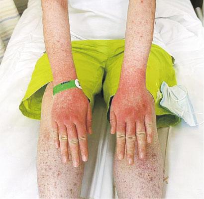 路边购仓鼠 杭女染恙虫病 全身红疹高烧 医生:延诊可致死