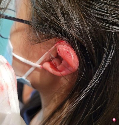 (已签发)柔:狮城二三事:一家四口游飞禽公园 13岁女生被鹦鹉啄伤左耳