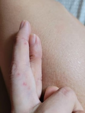 (已签发)柔:狮城二三事:一家四口游飞禽公园 13岁女生被鹦鹉啄伤左耳