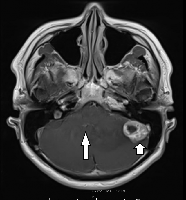 脑神经外科兼脊柱专科医生盛晓峰 / 耳鸣、行动迟缓 发现小脑血管细胞瘤需手术