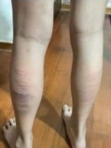 不满女儿考第5名 台父藤条狂打40多下