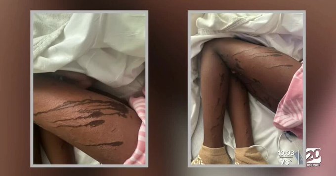 女童公园玩耍遭泼酸！凶手年仅12岁　竟是妈妈掏出一瓶酸让她复仇