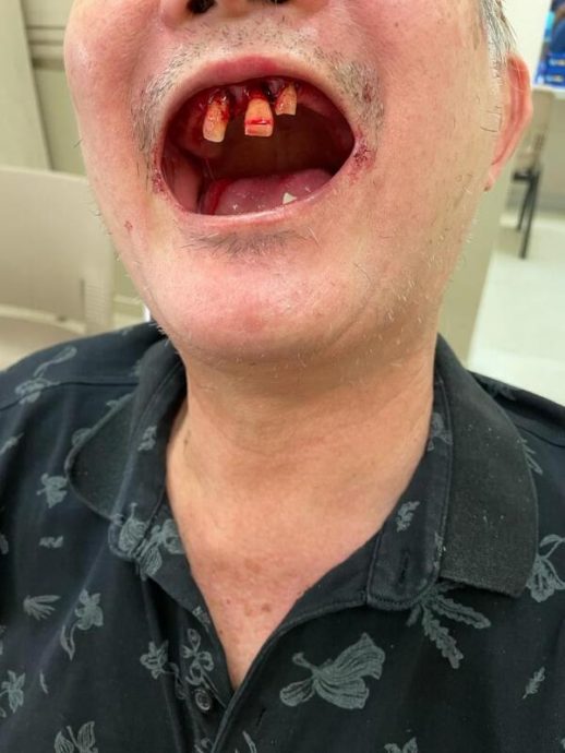 *已签发*柔：狮城二三事：商场挤电梯两家大混战 婴儿车掀翻七旬伯断3牙