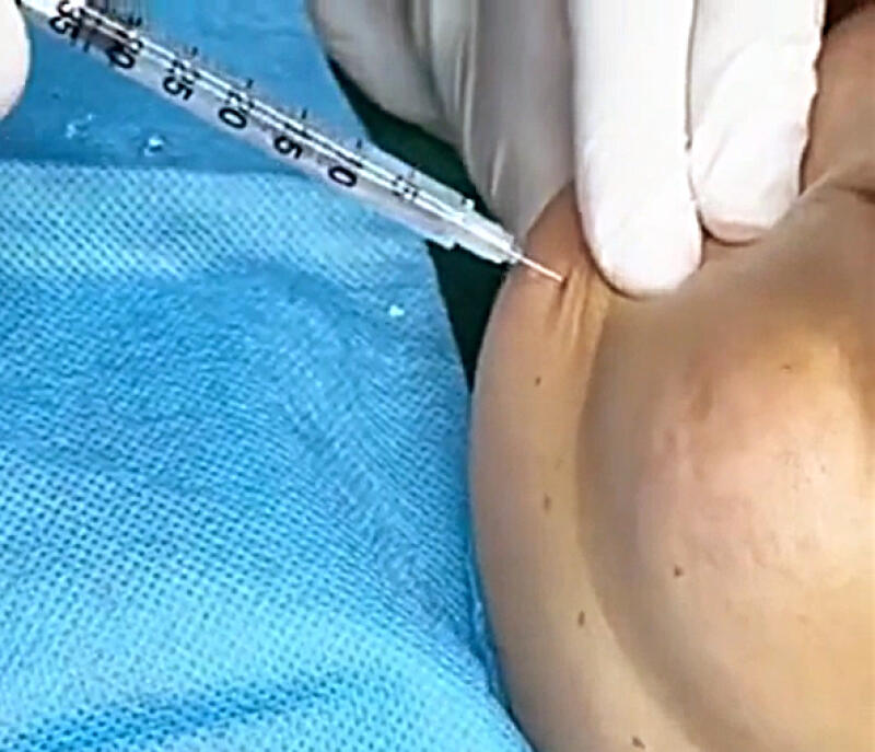 **已签发**柔:狮城二三事:越南女疑居家提供医美注射 狮城卫生部介入调查