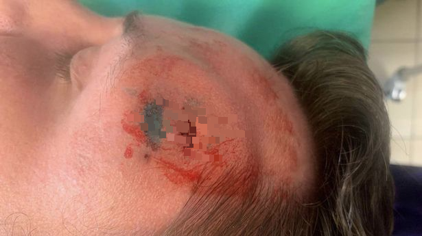 拼盘/男子额头肿起疼痛 医一切开拉出15公分白色寄生虫