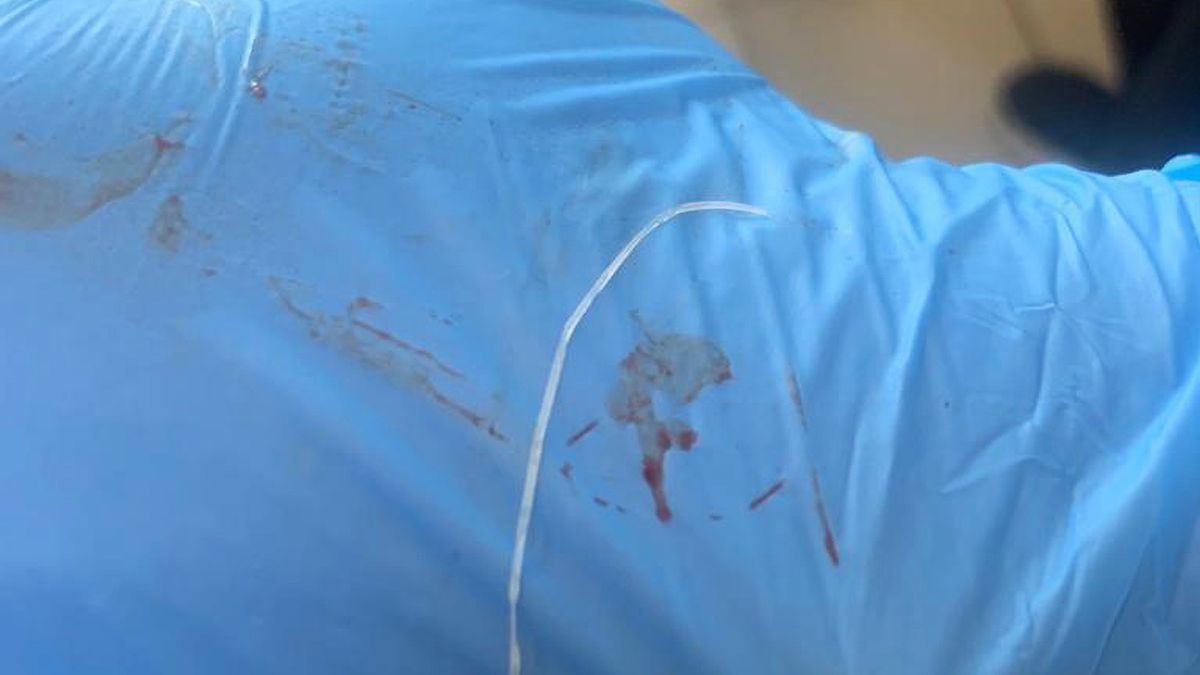 拼盘/男子额头肿起疼痛 医一切开拉出15公分白色寄生虫