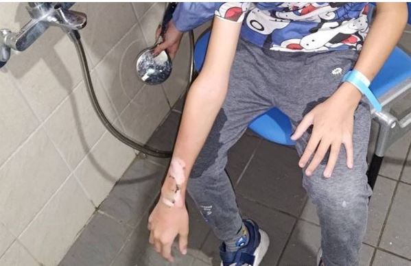 智能手表爆炸自燃 台10岁童炸伤或需植皮