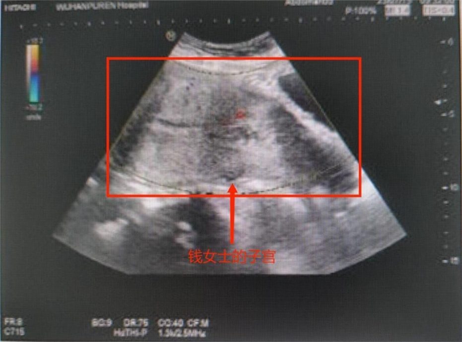 月经突排出“巴掌大肉团”!她吓傻求诊 医一查惊:是24周胎儿