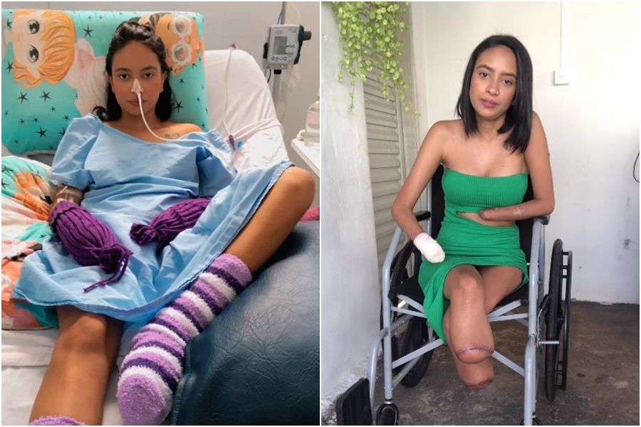 泌尿道感染扩散爆痛 女郎昏迷6天醒来截四肢