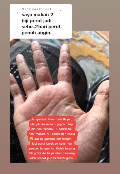 独家|女子吃完蟠桃送急症 营养师:果皮诱发过敏可能性大