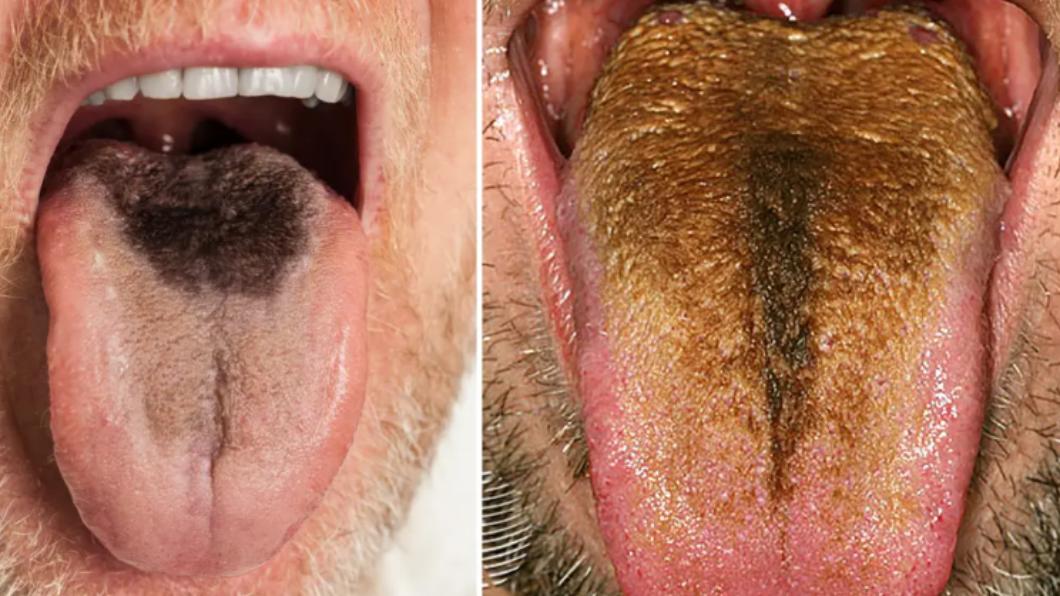  男子舌头长满“绿毛”太惊人  医生：常见在40岁以上人士