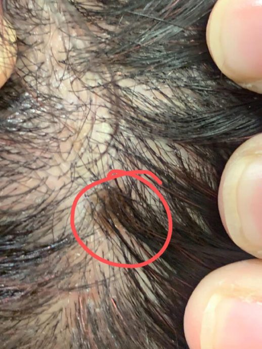 (已签发)柔:狮城二三事:妇女申诉被烫伤发型如狗咬 发廊:已请她回来检查