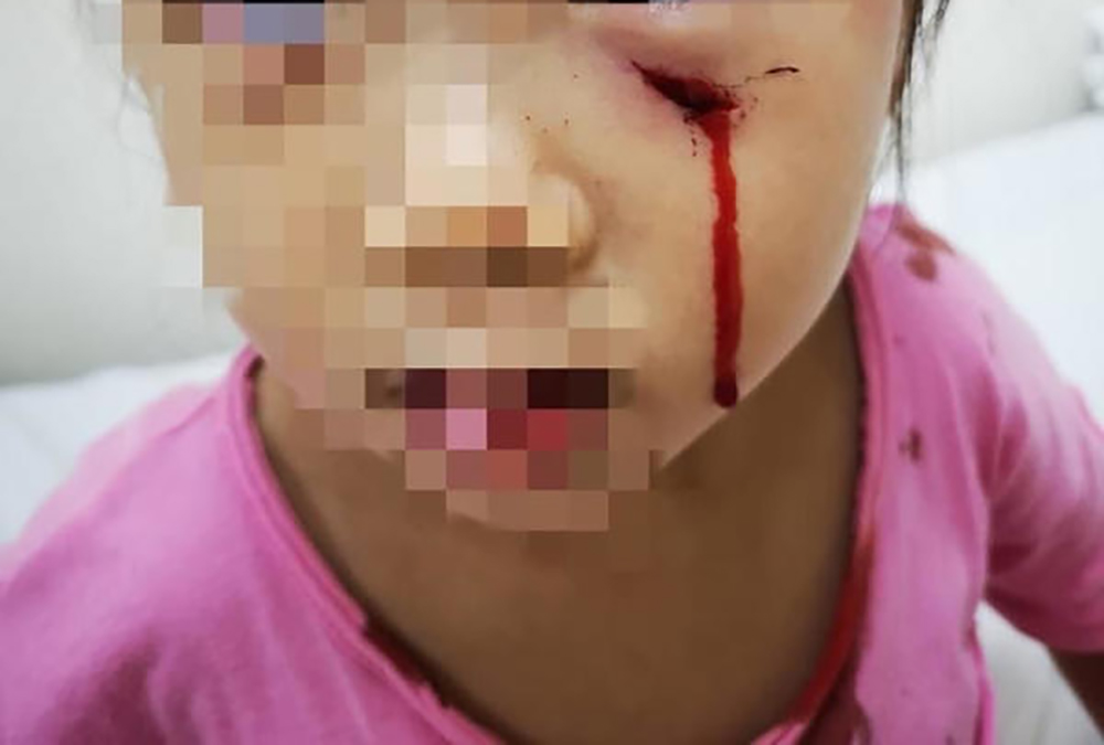 (已签发)柔:狮城二三事:家养孔雀袭击女童 家人起诉主人获赔偿