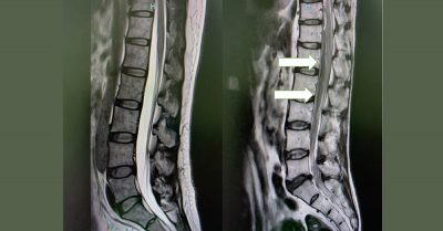 脑神经外科兼脊柱专科医生盛晓峰 / 通波仔后脊椎硬膜外出血  导致双脚无力兼失禁