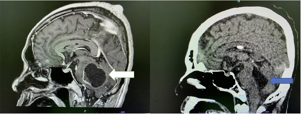 脑神经外科兼脊柱专科医生盛晓峰 / 右脑桥肿瘤位置深入颅底窝 手术后遗症饱受折磨