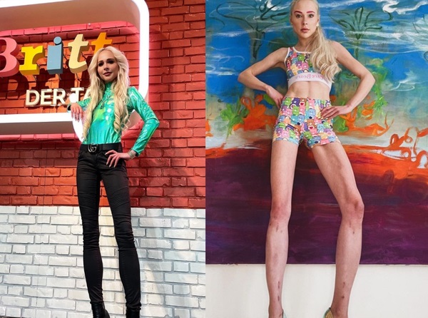 为夫喜好忍痛断骨增高 女模坦言非常后悔