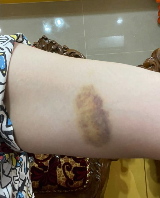 女商人控诉拿督丈夫家暴 “怀孕初期仍打我”