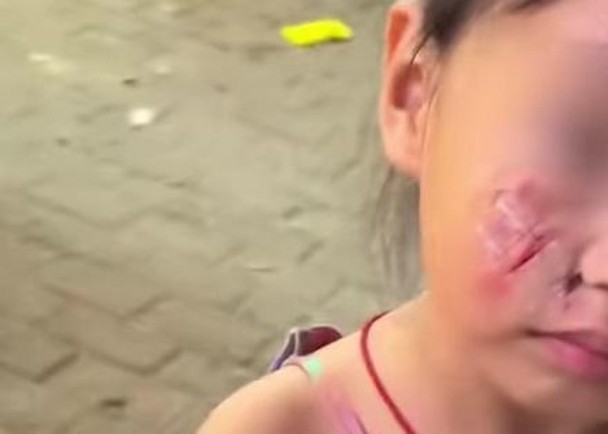 榴梿砸中女孩脸部留永久疤痕 母亲索赔店家失联