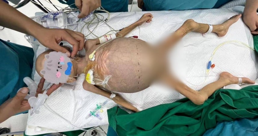 肚子肿胀快爆炸…两岁女童罹“儿童癌王”