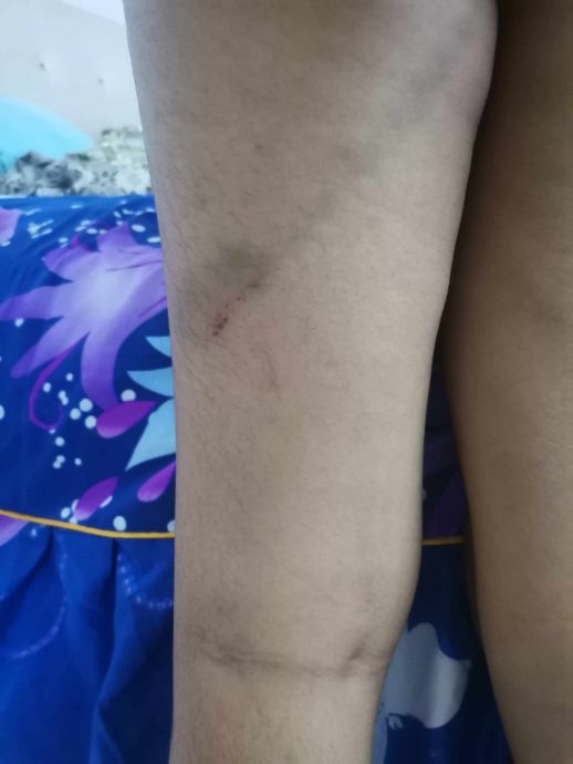 自闭儿疑在特殊学校遭虐待·母亲哑忍一年报警求助