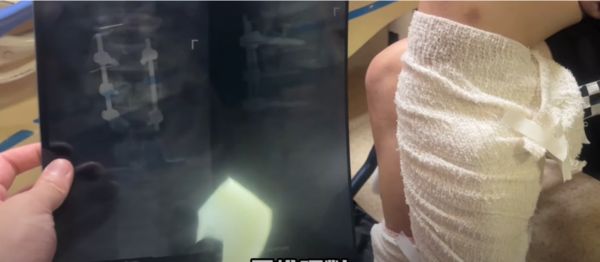 高雄男泰国酒吧喝到“孟婆汤”醒来送缅甸做诈骗　返台已半身不遂