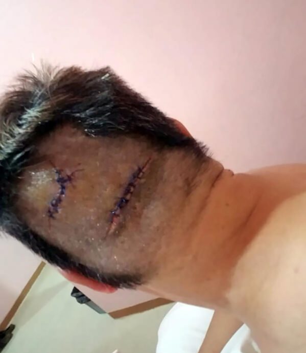 (已签发)柔:狮城二三事:男子凌晨峇淡遇袭 头部缝17针失财物