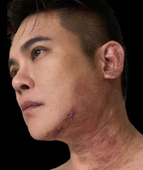 “生蛇”陷半脸面瘫  男星：痛得像被火烧