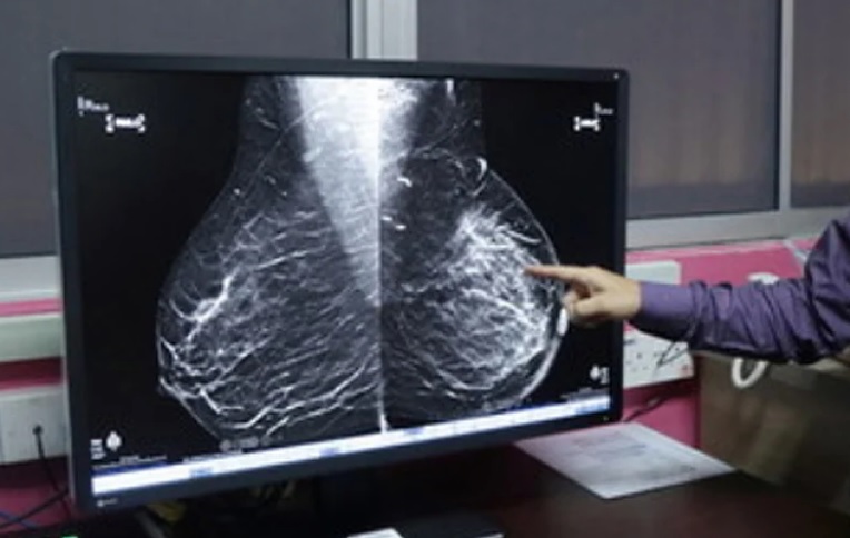 冠病影响癌症早期筛查 NCSM:乳腺结肠癌最多