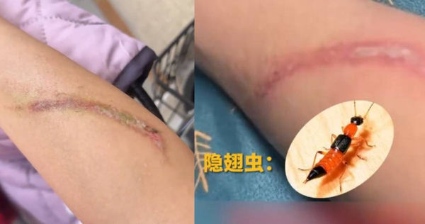 徒手捏爆“烦人小虫”　手臂竟出现骇人伤口！
