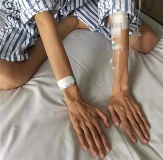 拼盘／13岁女孩患“天才病”身高破170公分　双手下垂长度超过膝盖