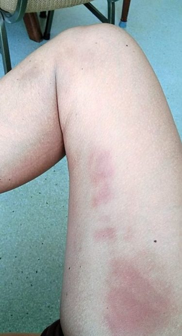 曾因长期冠病痛不欲生 记者:我挺过来了