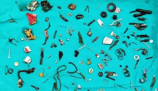 男子胃痛2年!医生开刀取出耳机、螺丝等60件杂物