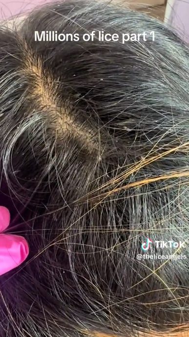 美国童“大量小虫发中爬行”　网民头皮发麻：看片都觉得痒