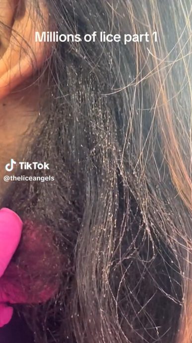 美国童“大量小虫发中爬行”　网民头皮发麻：看片都觉得痒