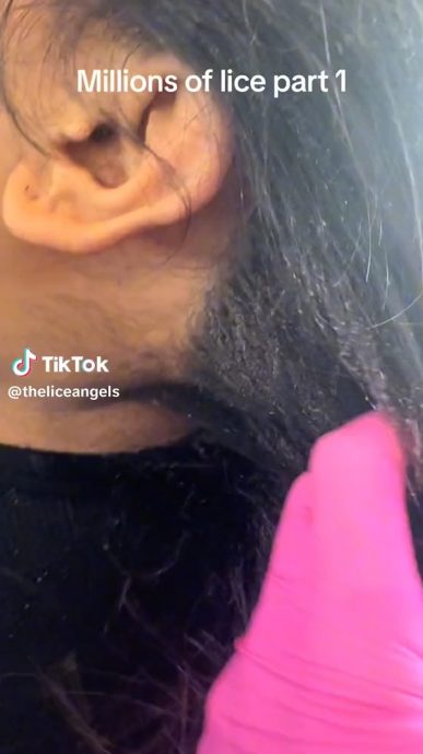 美国童“大量小虫发中爬行”　网民头皮发麻：看片都觉得痒