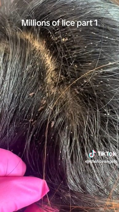 美国童“大量小虫发中爬行”　网民头皮发麻：看片都觉得痒