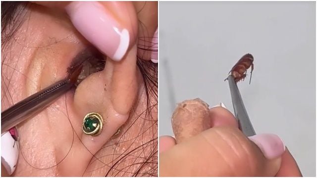 耳内狂传啵啵声! 她痛到求医竟夹出整只蟑螂