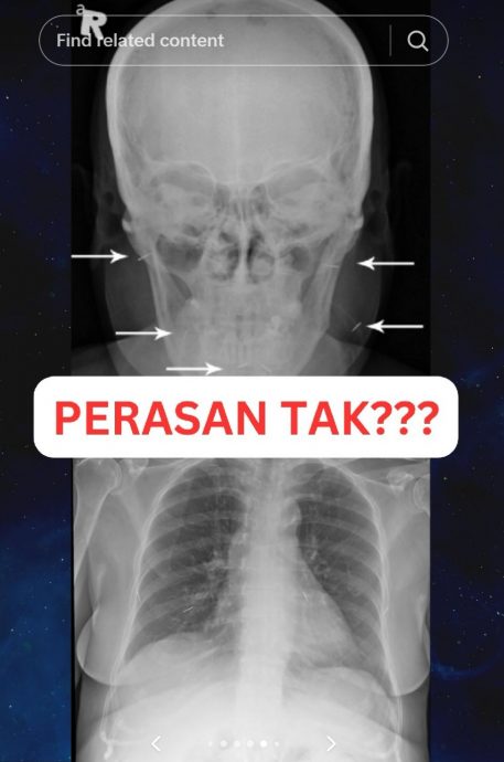  视频|中风妇女体内藏多针   医生傻眼：她死也不拔