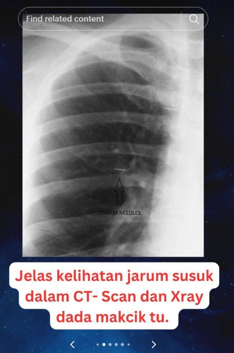  视频|中风妇女体内藏多针   医生傻眼：她死也不拔