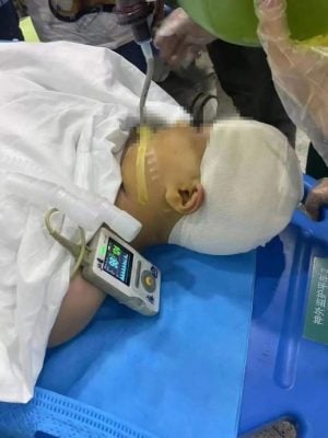 课堂上被老师打碎头骨 9岁女童开颅5小时 仍处危险期