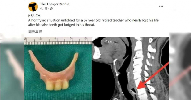 饭后吃药喉咙卡卡？　泰退休师误吞“整排假牙”急送医 